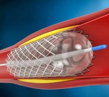 Anjiyo Balon Stent 360x320