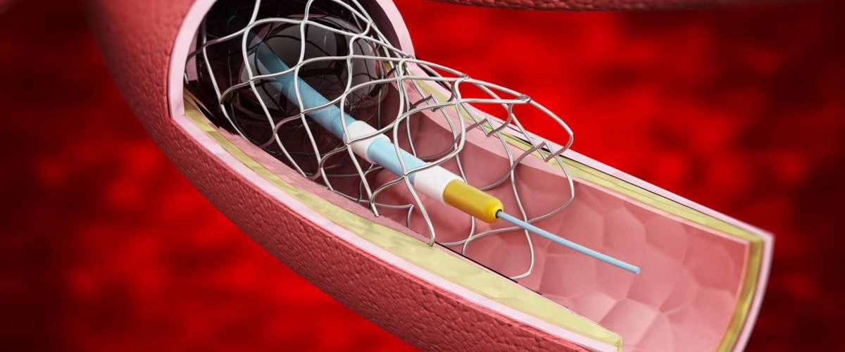 Balonstent 1200x500